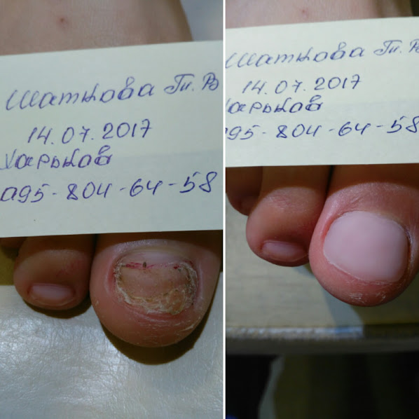 Фото 3. Комплексный уход за стопой, решение проблем грибка ногтей и кожи Харьков