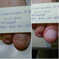 Комплексный уход за стопой, решение проблем грибка ногтей и кожи Харьков