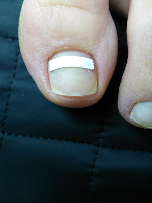 Фото 4. Комплексный уход за стопой, решение проблем грибка ногтей и кожи Харьков