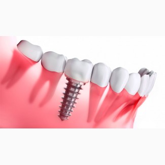 Високоякісна установка сучасного зубного імпланта із гарантією